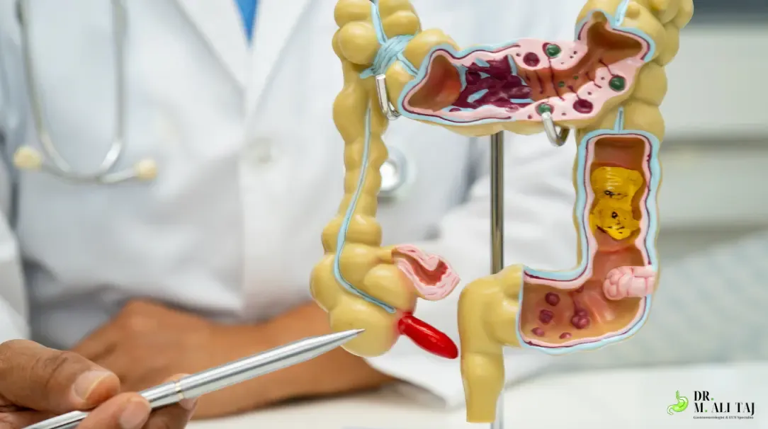 Doctor pointing to the appendix on an anatomical model of the large intestine, showing its location at the lower right