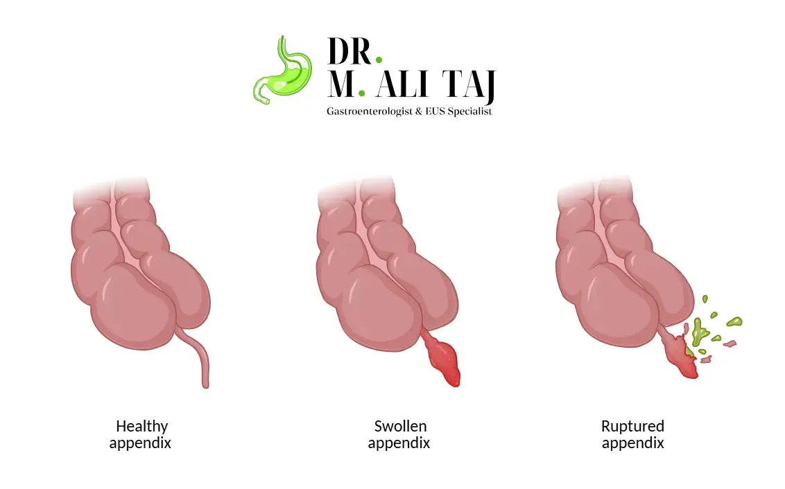 Medical illustration comparing a healthy appendix, a swollen (inflamed) appendix, and a ruptured appendix