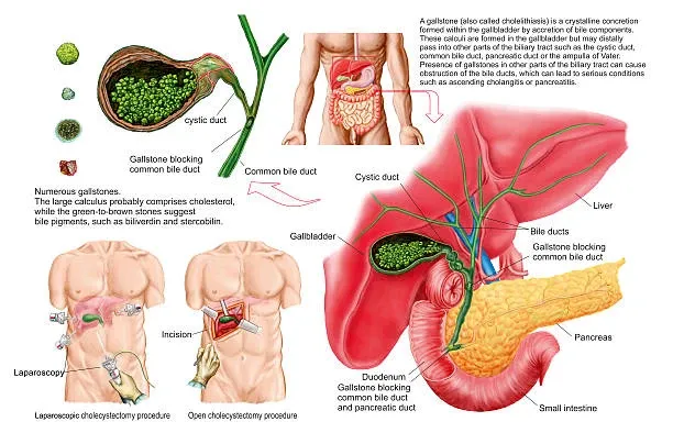 Bile duct obstruction and stone locations