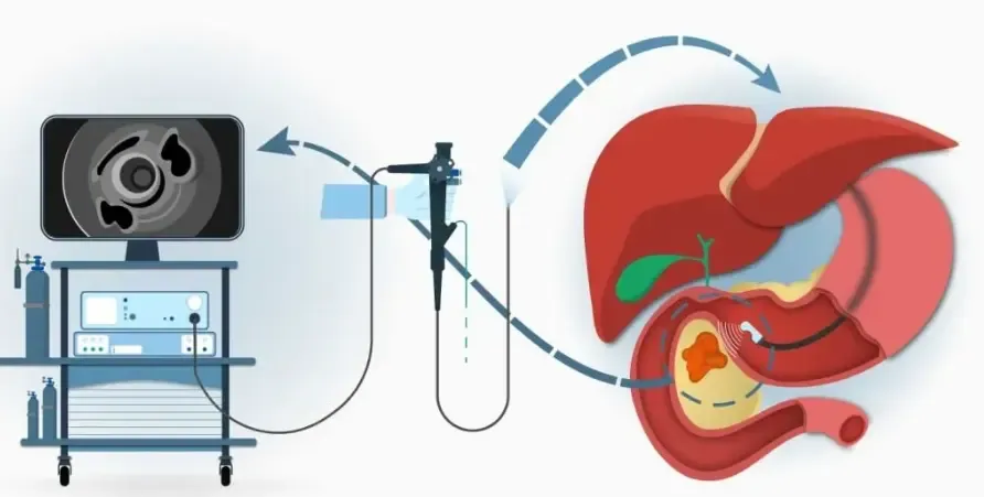 Anatomical illustration of an endoscopic ultrasound scope positioned inside the stomach to scan surrounding organs