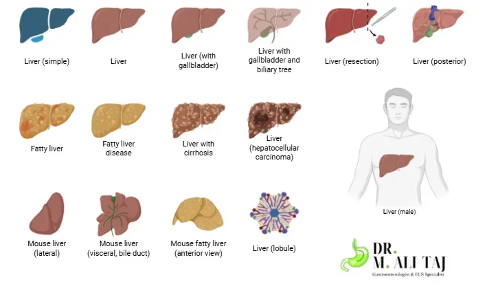 Medical chart illustrating different anatomical variations and conditions of the liver