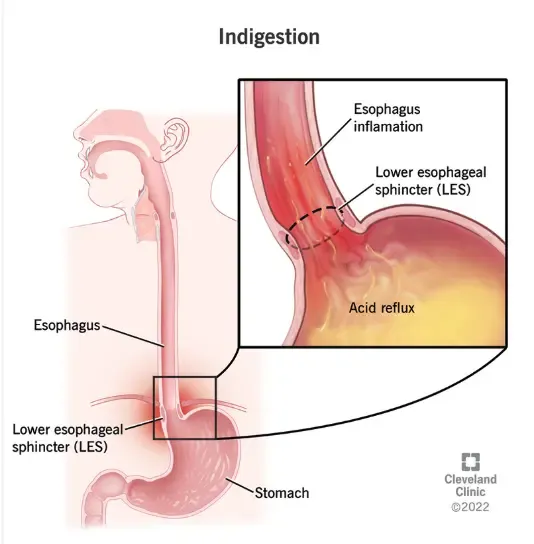 Upper Abdomen Discomfort