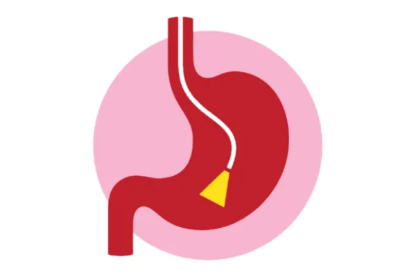 Illustration of an upper endoscopy procedure inspecting the esophagus and stomach