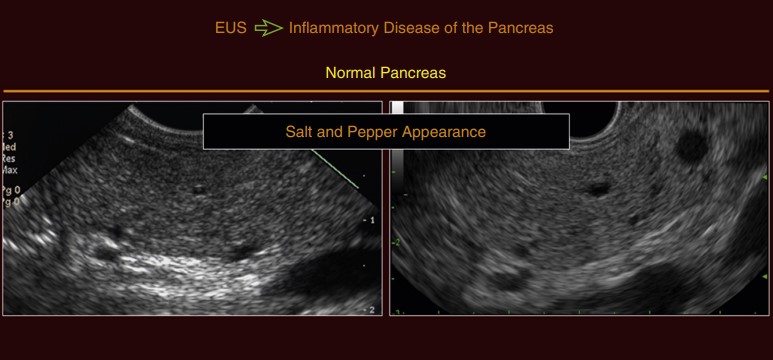 Endoscopic Ultrasound in Inflammatory Diseases of the Pancreas: A Critical Tool in Diagnosis