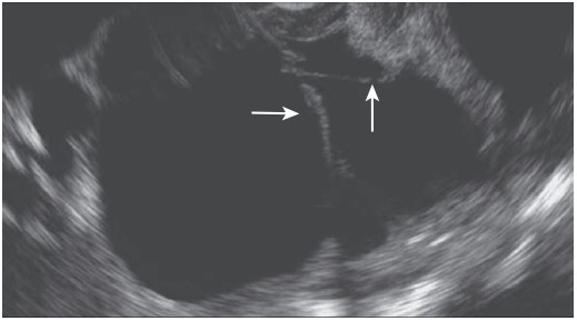 Endoscopic Ultrasonography: A Key Tool in Evaluating Pancreatic Cysts