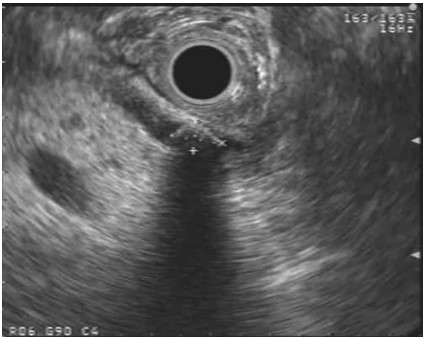Endoscopic Ultrasound in Bile Duct, Gallbladder, and Ampullary Lesions