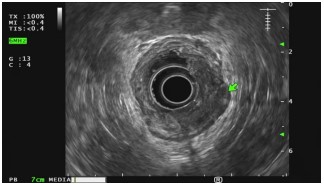 Anorectal Endoscopic Ultrasonography: A Comprehensive Overview