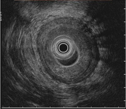 Endoscopic Ultrasonography in Rectal Cancer: Enhancing Therapeutic Decision-Making
