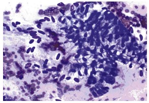 The Critical Role of Cytopathology in EUS-FNA