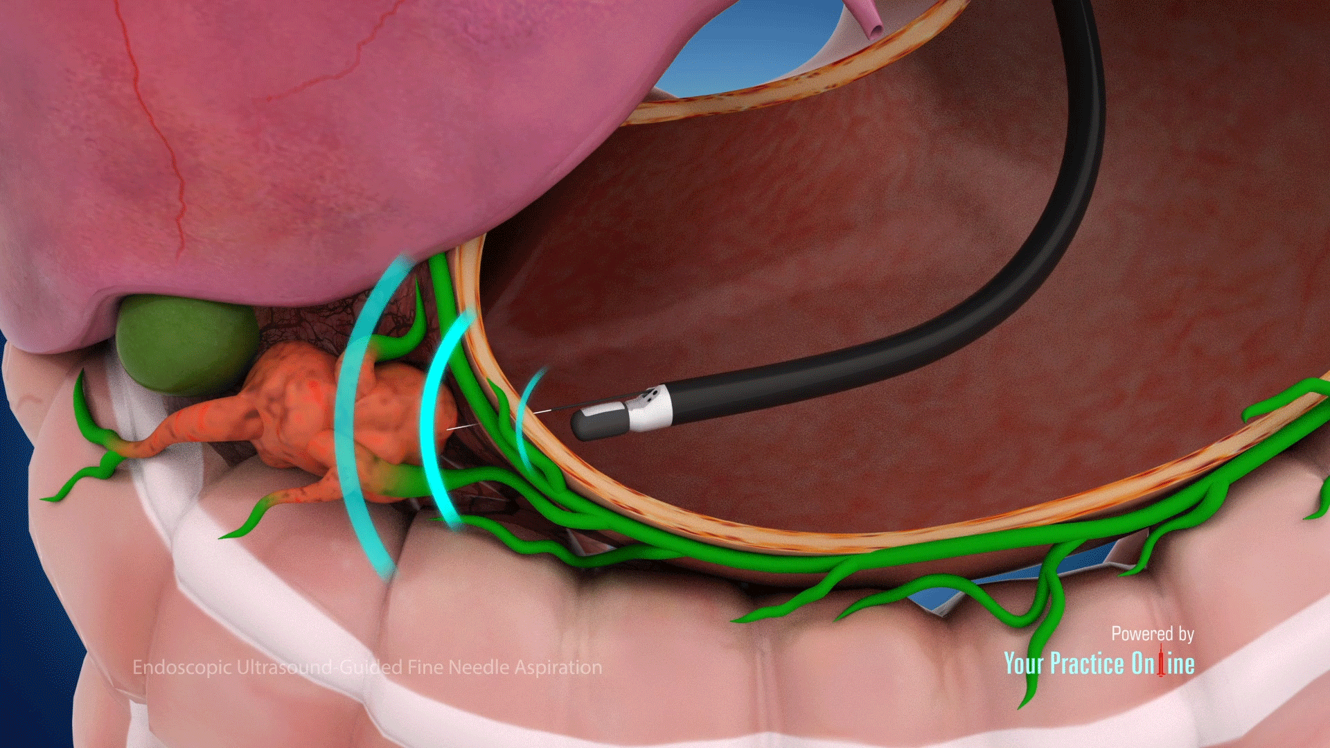 3D medical rendering from file eus-fna.jpg displaying an echoendoscope tip within the stomach wall emitting acoustic ultrasound waves, marked as blue concentric paths, to pinpoint an adjacent orange tumor mass next to lymphatic networks