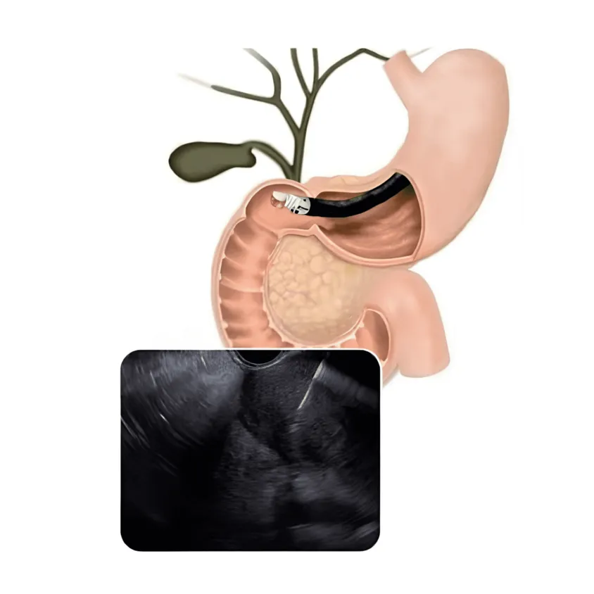 Minimalist vector graphic illustrating an endoscopy tube inserted into the stomach, emitting curved sound waves from its tip
