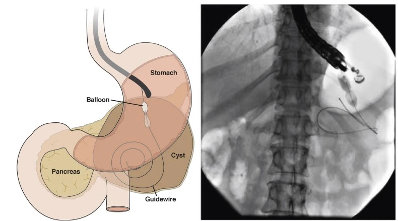 Endoscopic Ultrasound-Guided drainage of pancreatic pseudocysts