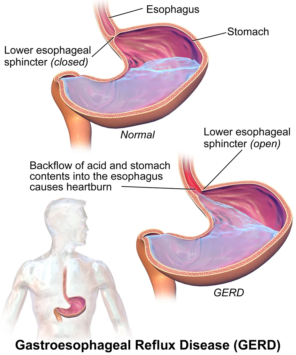 Understanding GERD: A Comprehensive Guide