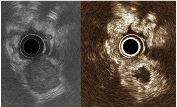 Understanding Subepithelial Lesions in Gastroenterology: A Deep Dive into Diagnosis and Management