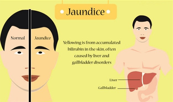 Understanding Jaundice: Causes, Symptoms, and Treatments