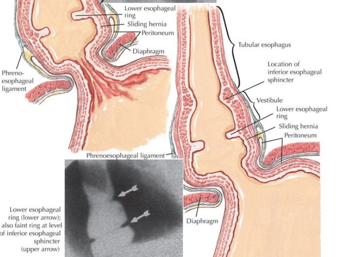 Benign Diseases of the Esophagus: Esophageal Rings, Webs, and Plummer-Vinson Syndrome