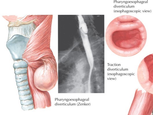 Esophageal Diverticula: Causes, Diagnosis, and Treatments