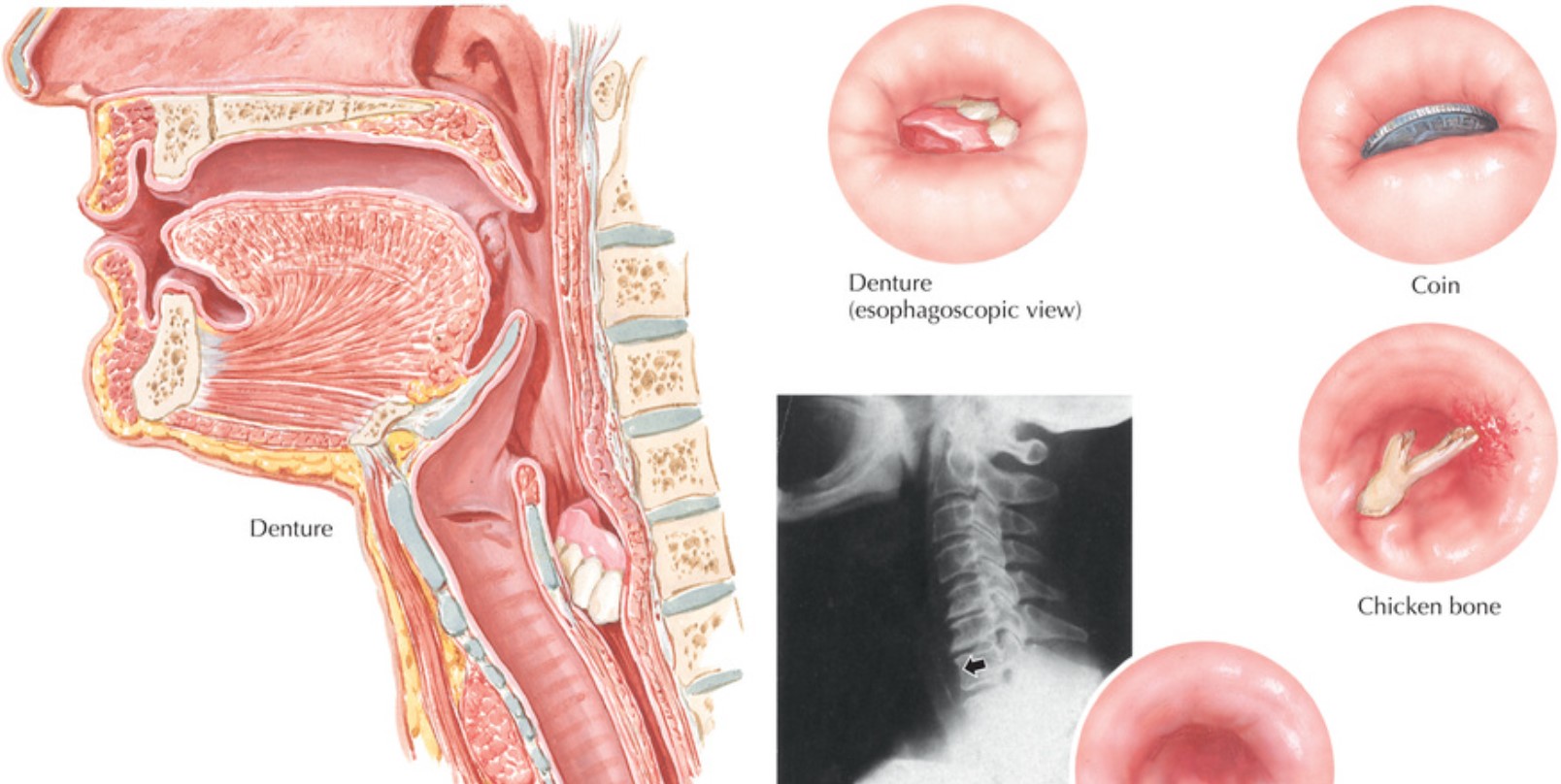Foreign Bodies in the Esophagus: Causes, Symptoms, and Treatments