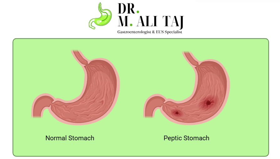 Peptic Ulcer : Maida ulcer treatment in Urdu