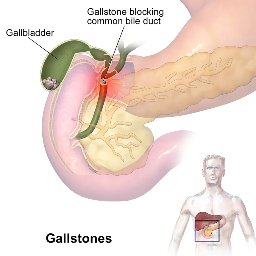 Effective Treatments for Biliary Stones