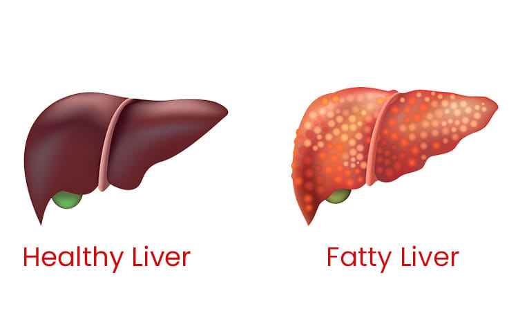 Fatty Liver Treatment Karachi - Best Hepatologist | Dr. Ali Taj