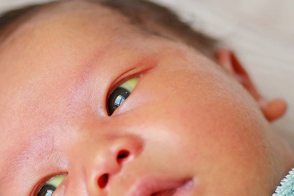 Jaundice Treatment in Children - Pediatric Jaundice Specialist | Dr. Ali Taj Karachi