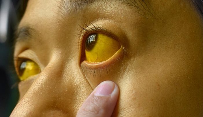 Yarkan Ki Alamat - Complete Guide to Jaundice Symptoms and Treatment