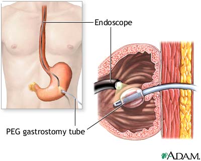 Percutaneous Endoscopic Gastrostomy (PEG)